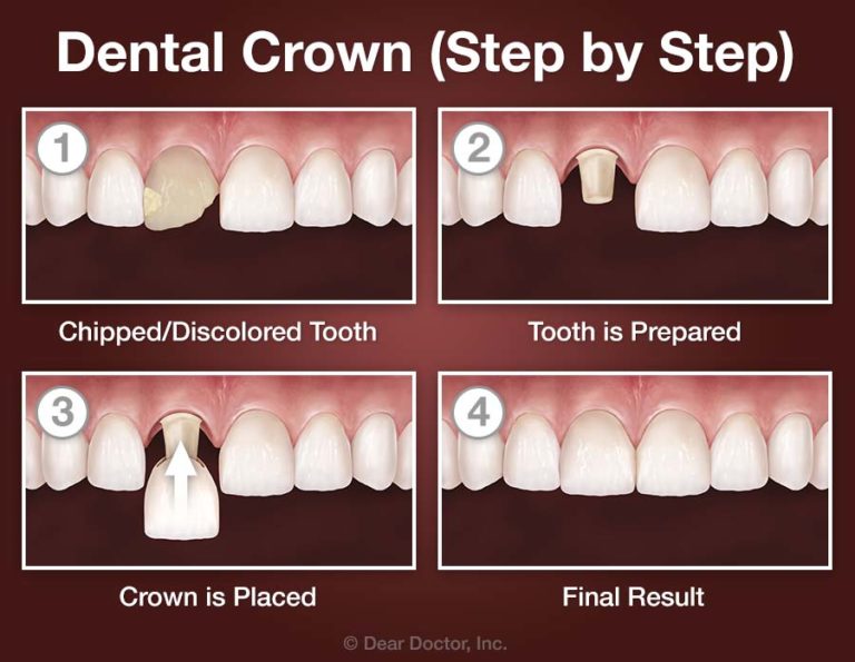CROWNS