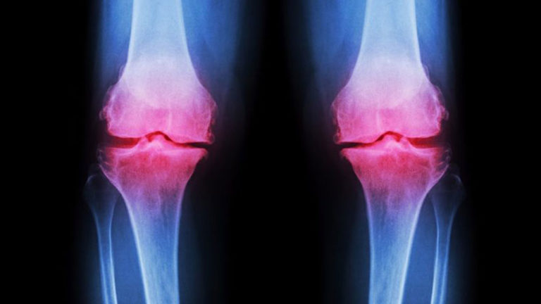 ARTHRITIS