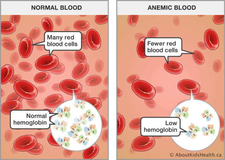 ANEMIA