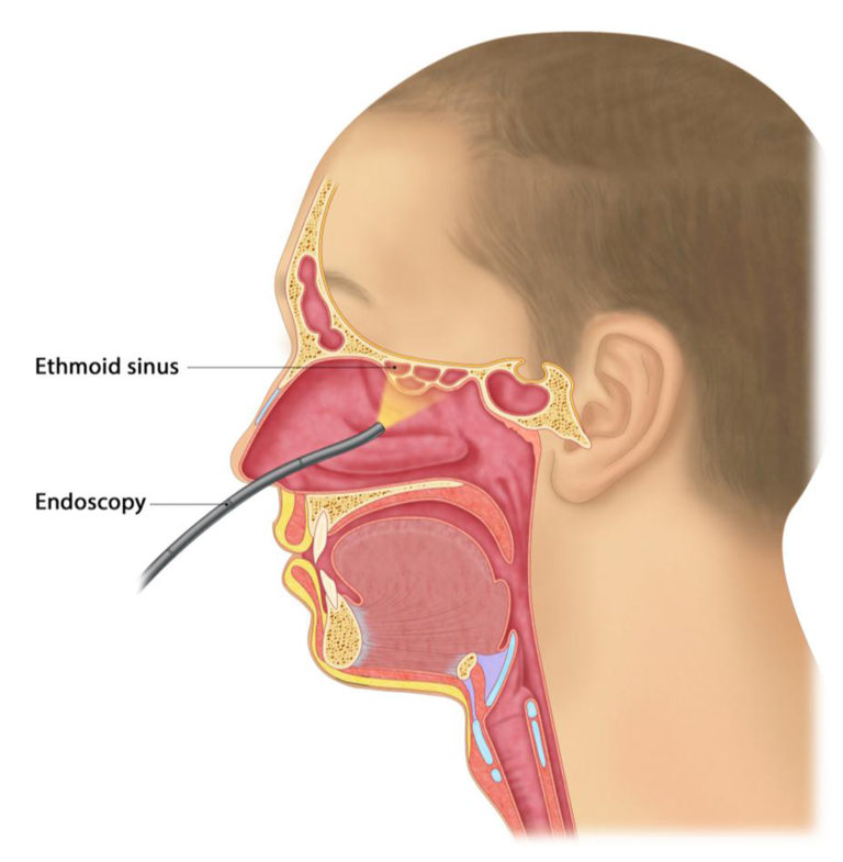 SINUSITIS