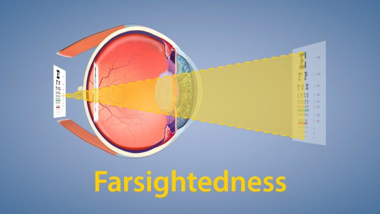 FARSIGHTEDNESS
