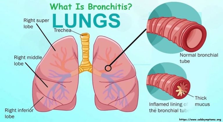 BRONCHITIS