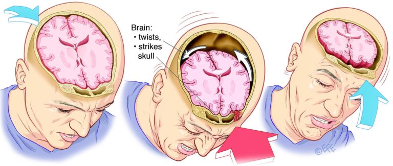 BRAIN CONCUSSION
