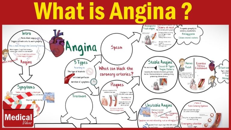 ANGINA