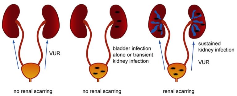 BLADDER / KIDNEY INFECTION