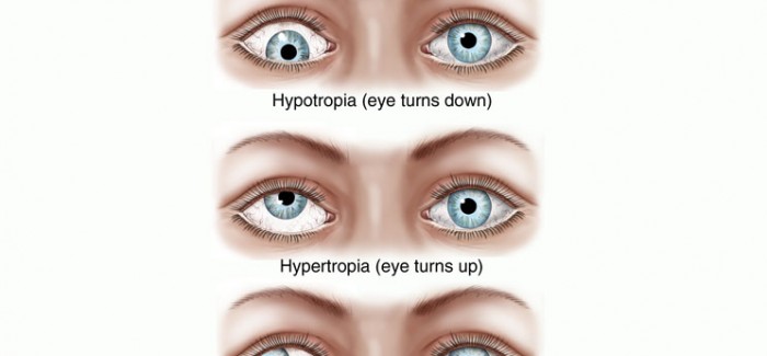 CROSS EYE