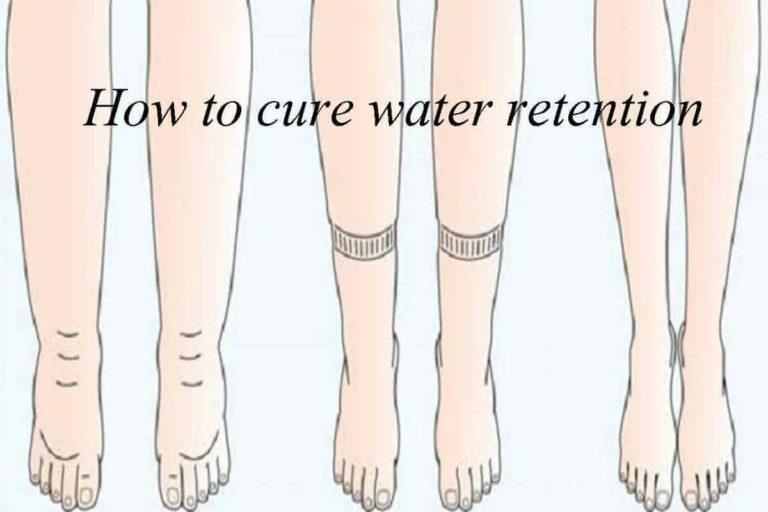 WATER IN THE LEGS
