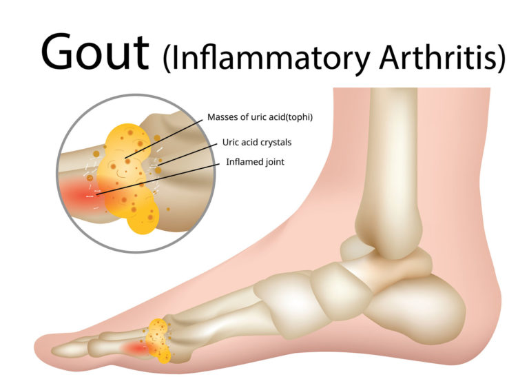 GOUT-Medecines