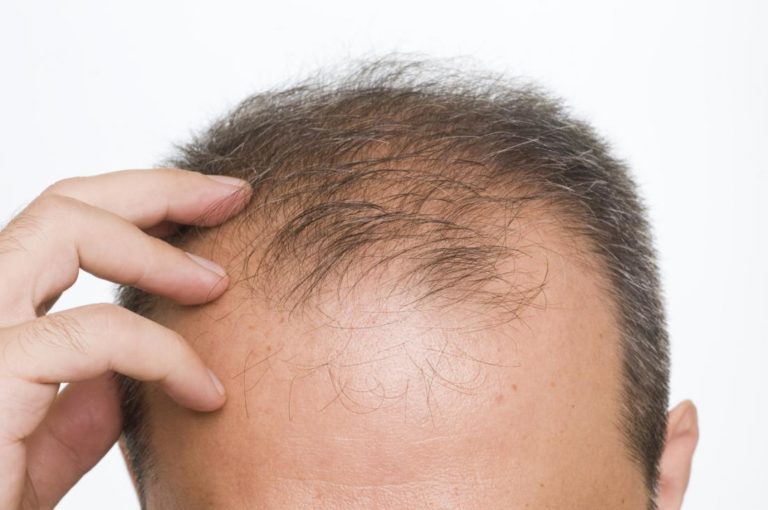 HAIR-LOSS