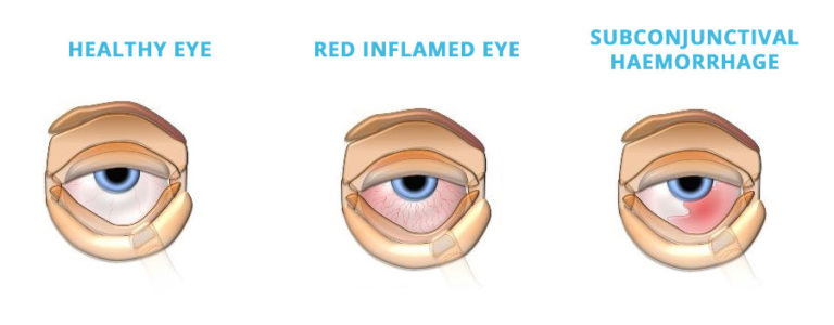 EYE-INFECTION