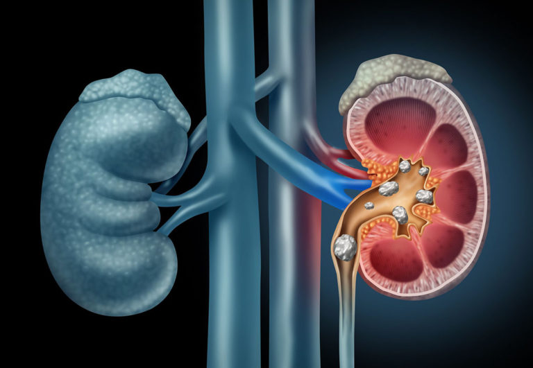 KIDNEY-STONES