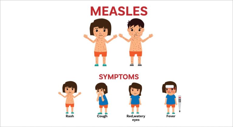 MEASLES