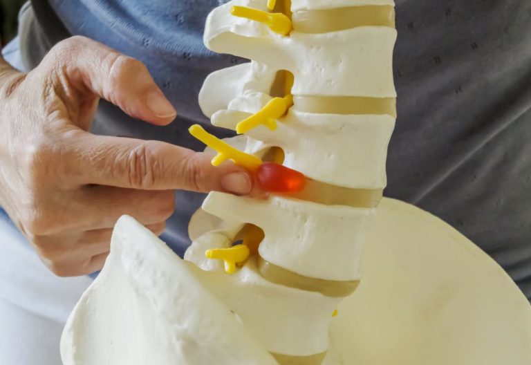 PROLAPSED INTER VERTEBRAL DISCS