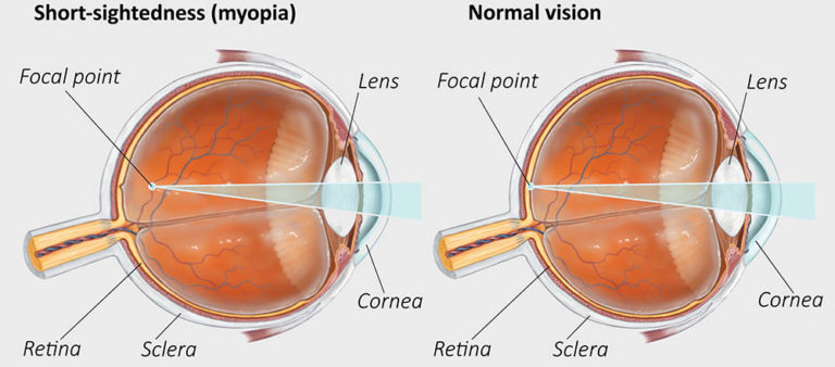 SHORT-SIGHTEDNESS
