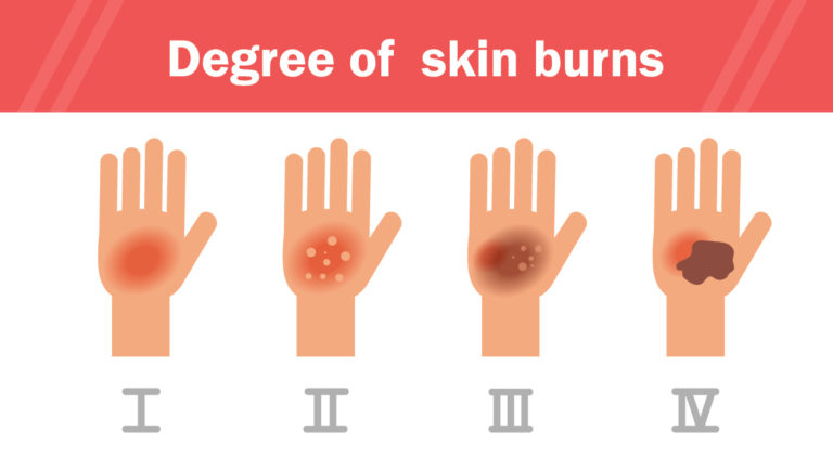 BURNS