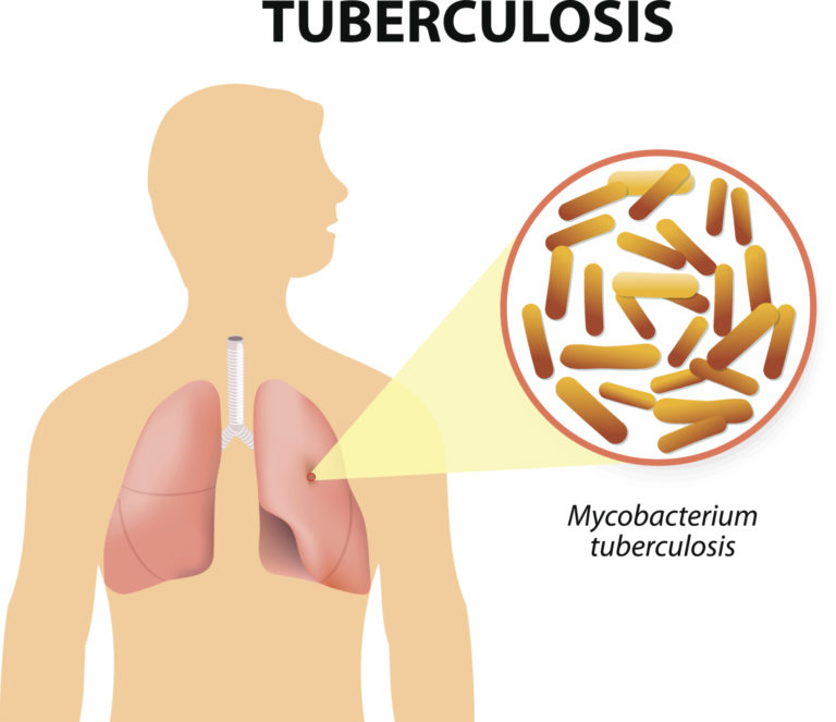 TUBERCULOSIS