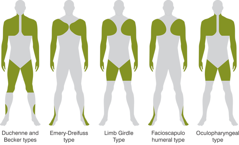 MUSCULAR DYSTROPHY