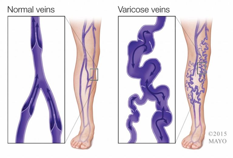 VERICOSE VEINS